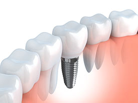 Boulevard Center for Advanced Dentistry | Port St. Lucie Dentist | Single Tooth Implants