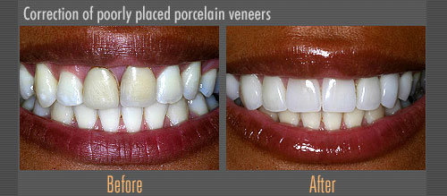 Porcelain Veneers | Boulevard Center for Advanced Dentistry | Port St. Lucie Dentist