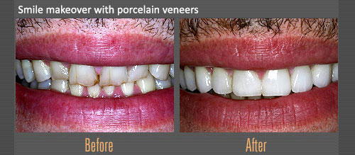Smile Makeover Porcelain Veneers | Boulevard Center for Advanced Dentistry | Port St. Lucie Dentist