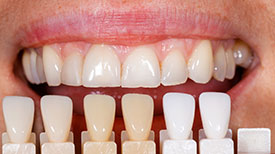 Boulevard Center for Advanced Dentistry | Port St. Lucie Dentist | Porcelain Veneers