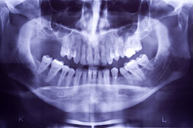 Boulevard Center for Advanced Dentistry | Port St. Lucie Dentist | Dental X-Ray